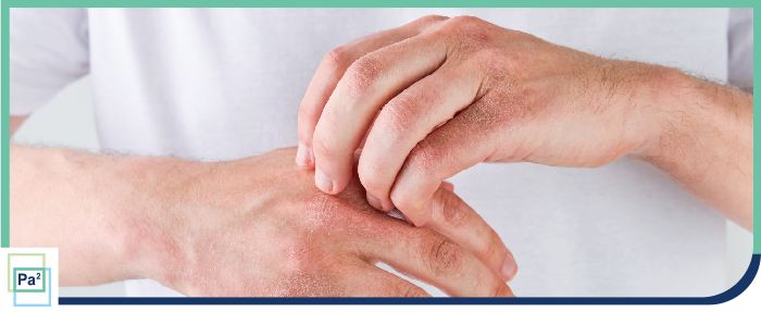 What Are the 5 Stages of an Allergic Reaction? | Piniella Asthma + Allergy in Coral Gables, FL and Palmetto Bay, FL